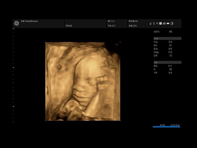 GE Versana Essential