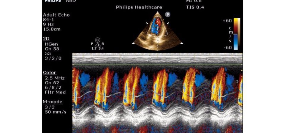 Philips ClearVue 850