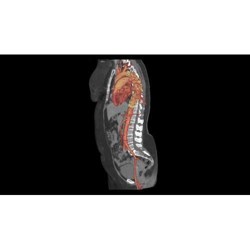 КТ аппарат GE Revolution CT